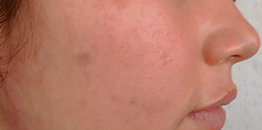 antes y despues tratamiento dermatología