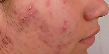 antes y despues tratamiento dermatología